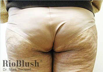 Cellulite marks before
